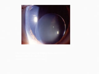 Microspherophakia and  spontaneous  inferior  dislocation  of a  lens  in a  ... emedicine.medscape.com 