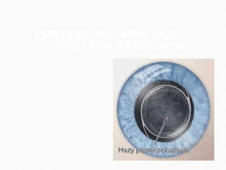 POSTERIOR CAPSULAR  OPACIFICATION(PCO)  