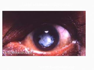 DENSE MEMBRANOUS CATARACT SOURCE:eyerounds.org 