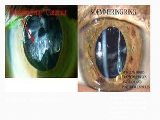 SOURCE:revoptom.com New lens fibres trapped between the anterior and posterior capsules  