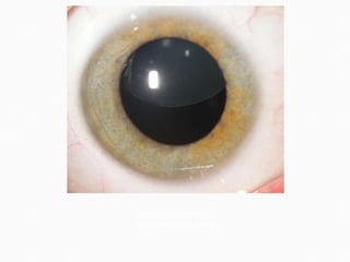 Subluxated  lens . eyecareamerica.org 