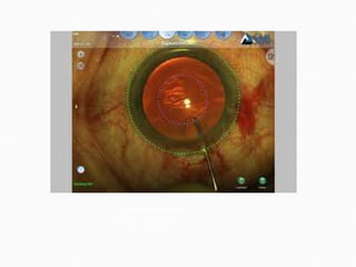 capsulorhexis   surgery-guidance.com  