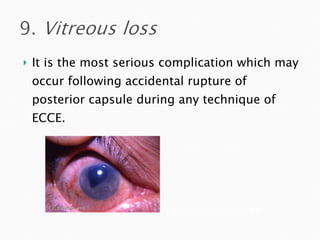 It is the most serious complication which may occur following accidental rupture of posterior capsule during any technique of ECCE. webeye.ophth.uiowa.edu  