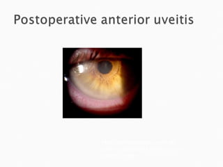 http://lifeinthefastlane.com/wp-content/uploads/2010/08/anterior-uveitis-21.jpg 