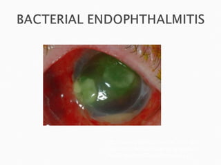 http://www.pfofflaserandeye.com/The%20Informed%20Patient/Dangerous%20Symptoms/Endophthalmitis.gif 