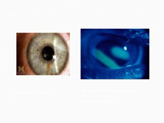disease-picture.com  Corneal abrasion  seen with fluorescein stain. bestpractice.bmj.com 