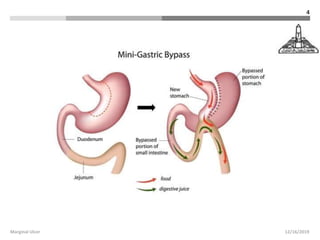 Complications of bariatric surgery | PPTX