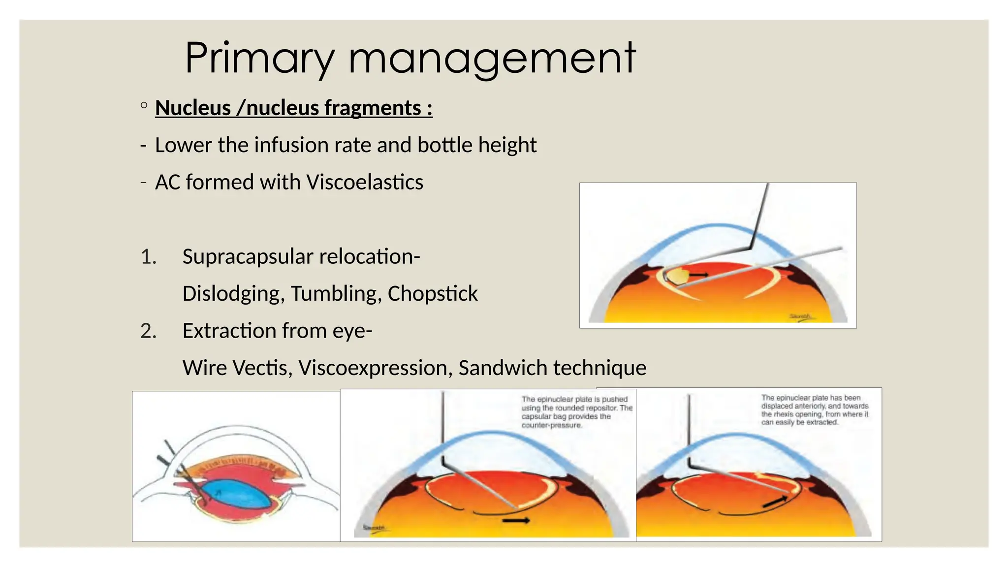 Primary management
◦ Nucleus /nucleus fragments :
- Lower the infusion rate and bottle height
- AC formed with Viscoelastics
1. Supracapsular relocation-
Dislodging, Tumbling, Chopstick
2. Extraction from eye-
Wire Vectis, Viscoexpression, Sandwich technique
 