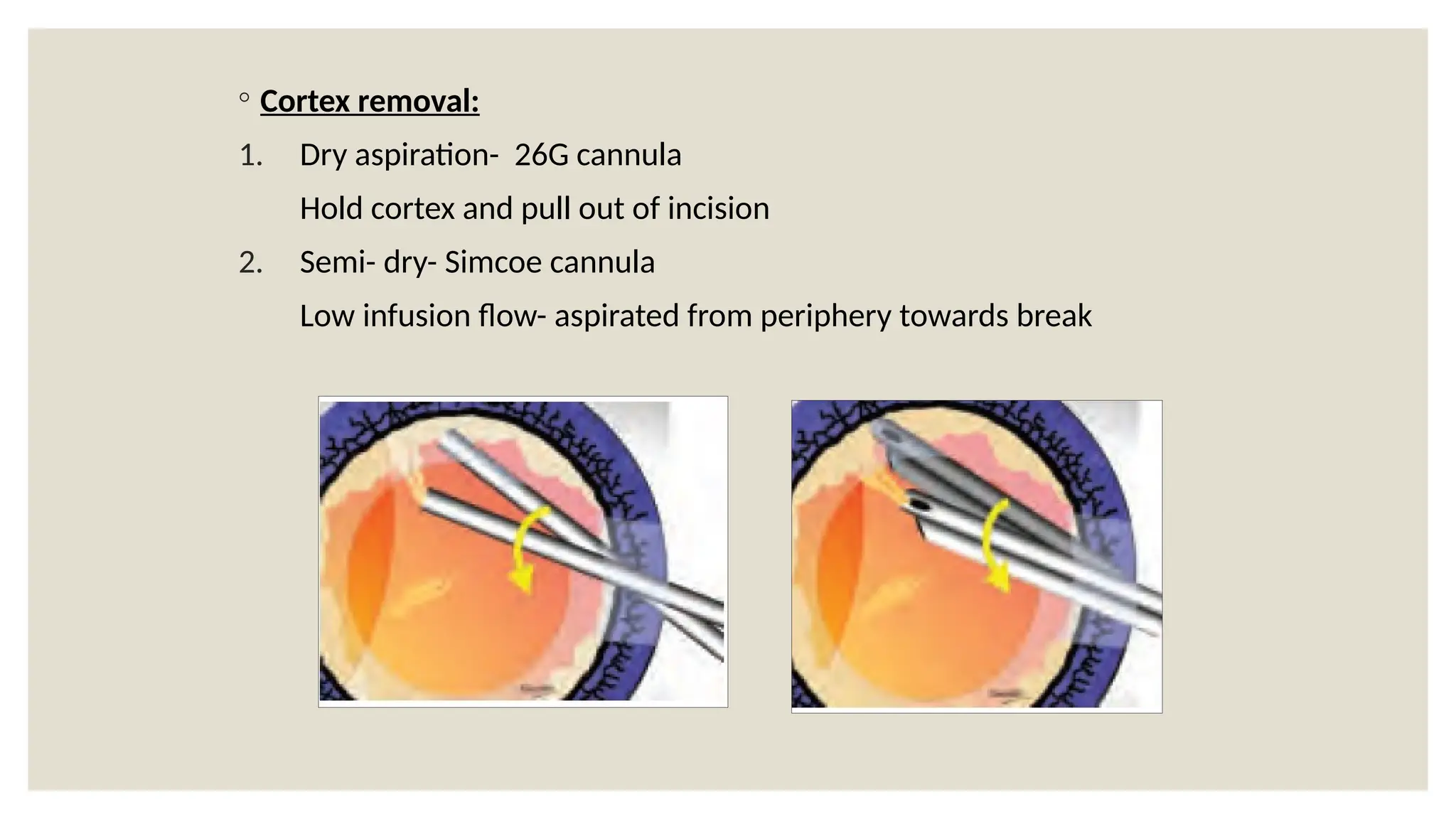 ◦ Cortex removal:
1. Dry aspiration- 26G cannula
Hold cortex and pull out of incision
2. Semi- dry- Simcoe cannula
Low infusion flow- aspirated from periphery towards break
 