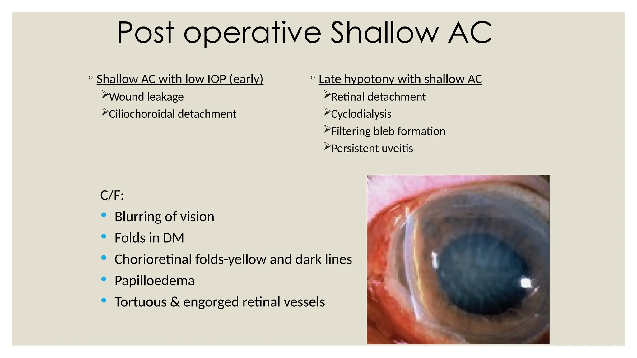 Post operative Shallow AC
◦ Shallow AC with low IOP (early)
Wound leakage
Ciliochoroidal detachment
◦ Late hypotony with shallow AC
Retinal detachment
Cyclodialysis
Filtering bleb formation
Persistent uveitis
C/F:
 Blurring of vision
 Folds in DM
 Chorioretinal folds-yellow and dark lines
 Papilloedema
 Tortuous & engorged retinal vessels
 