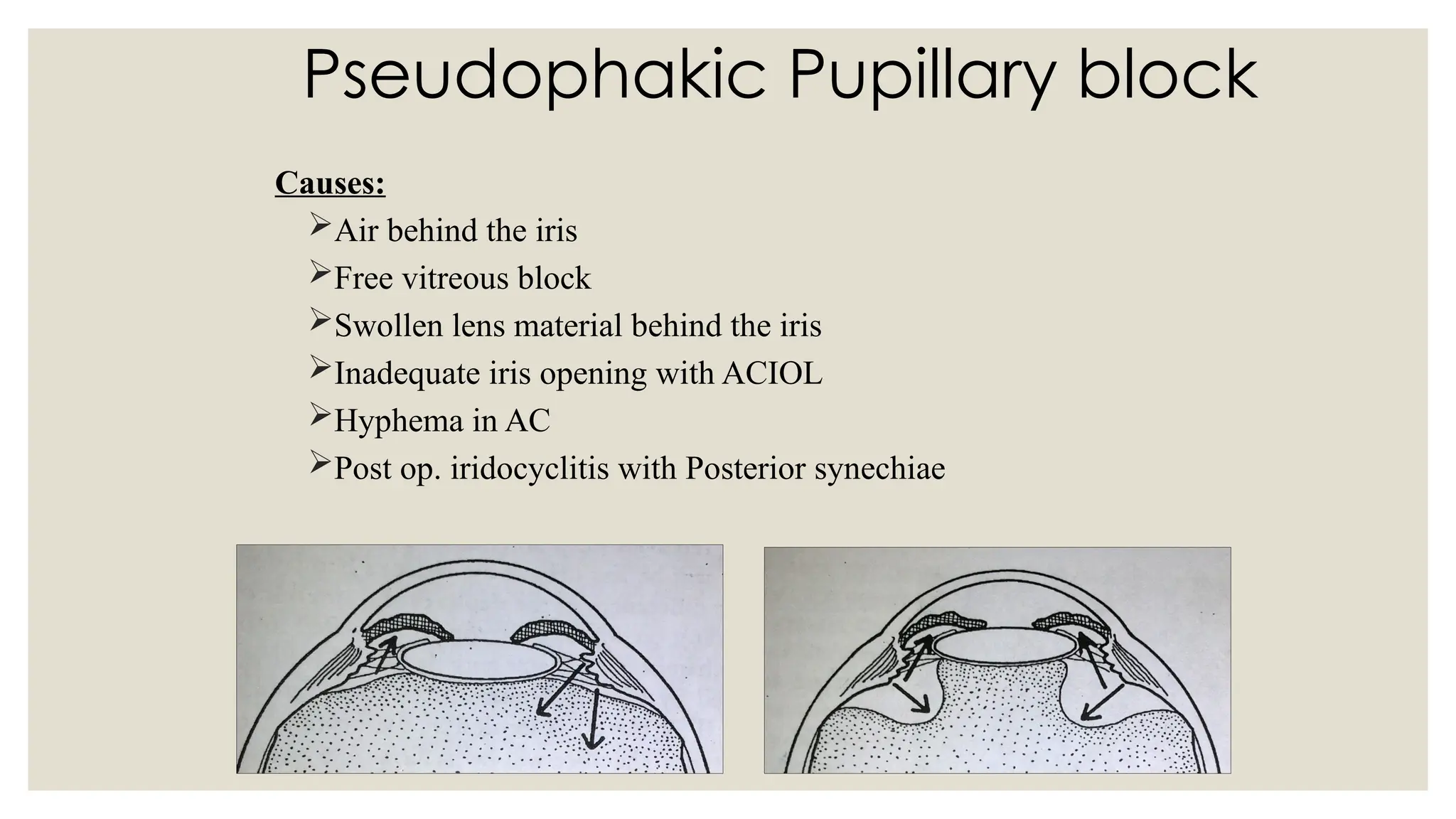 Pseudophakic Pupillary block
Causes:
Air behind the iris
Free vitreous block
Swollen lens material behind the iris
Inadequate iris opening with ACIOL
Hyphema in AC
Post op. iridocyclitis with Posterior synechiae
 