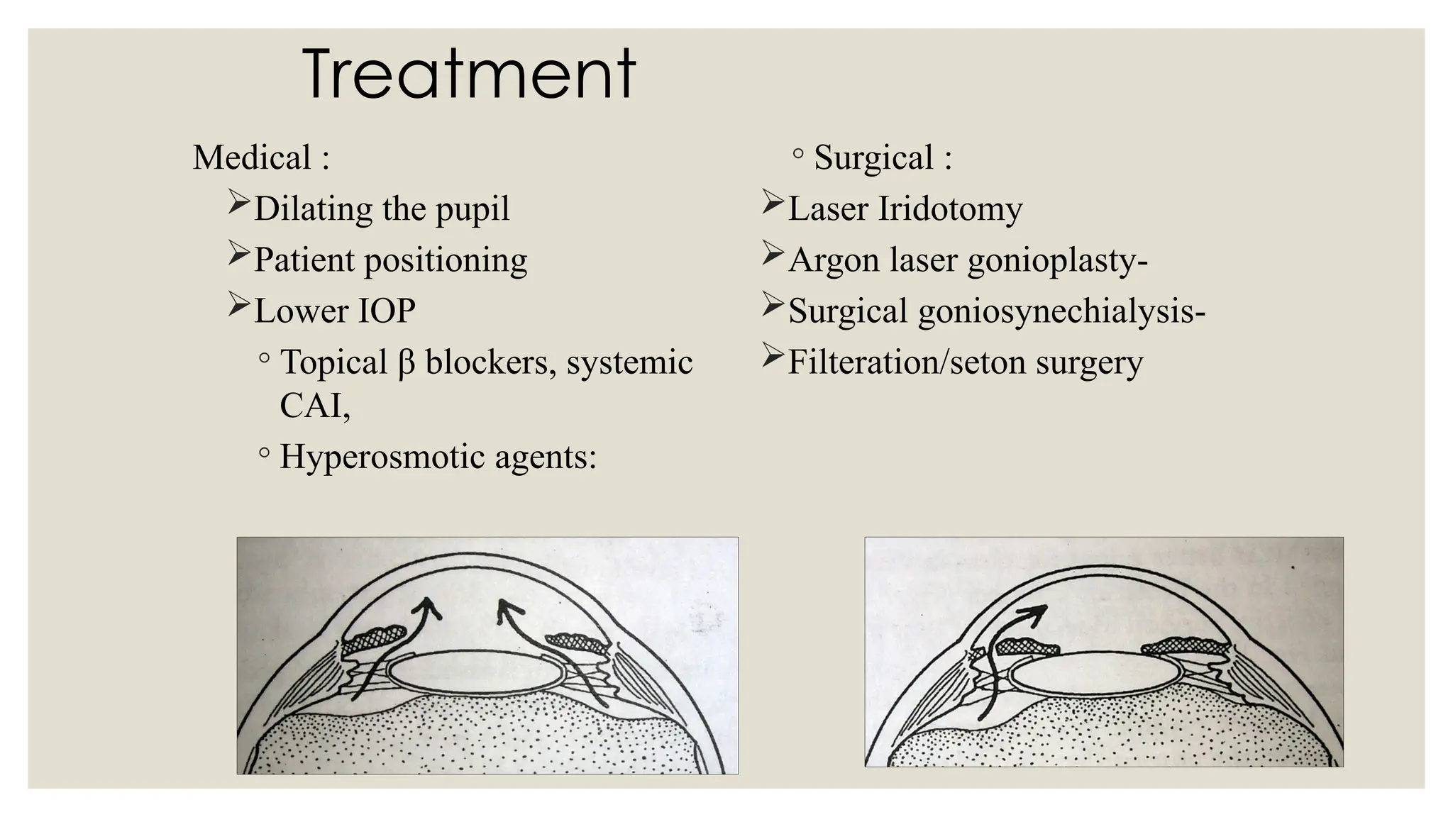 Treatment
Medical :
Dilating the pupil
Patient positioning
Lower IOP
◦ Topical β blockers, systemic
CAI,
◦ Hyperosmotic agents:
◦ Surgical :
Laser Iridotomy
Argon laser gonioplasty-
Surgical goniosynechialysis-
Filteration/seton surgery
 