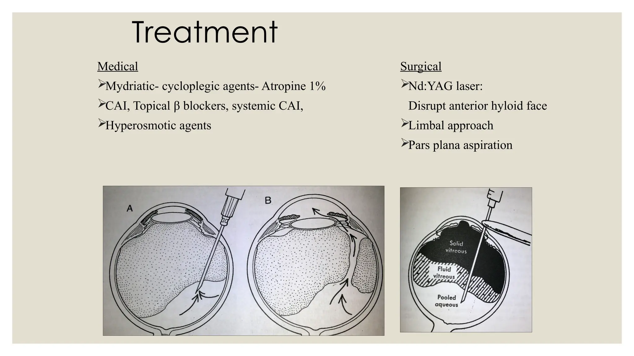 Treatment
Medical
Mydriatic- cycloplegic agents- Atropine 1%
CAI, Topical β blockers, systemic CAI,
Hyperosmotic agents
Surgical
Nd:YAG laser:
Disrupt anterior hyloid face
Limbal approach
Pars plana aspiration
 