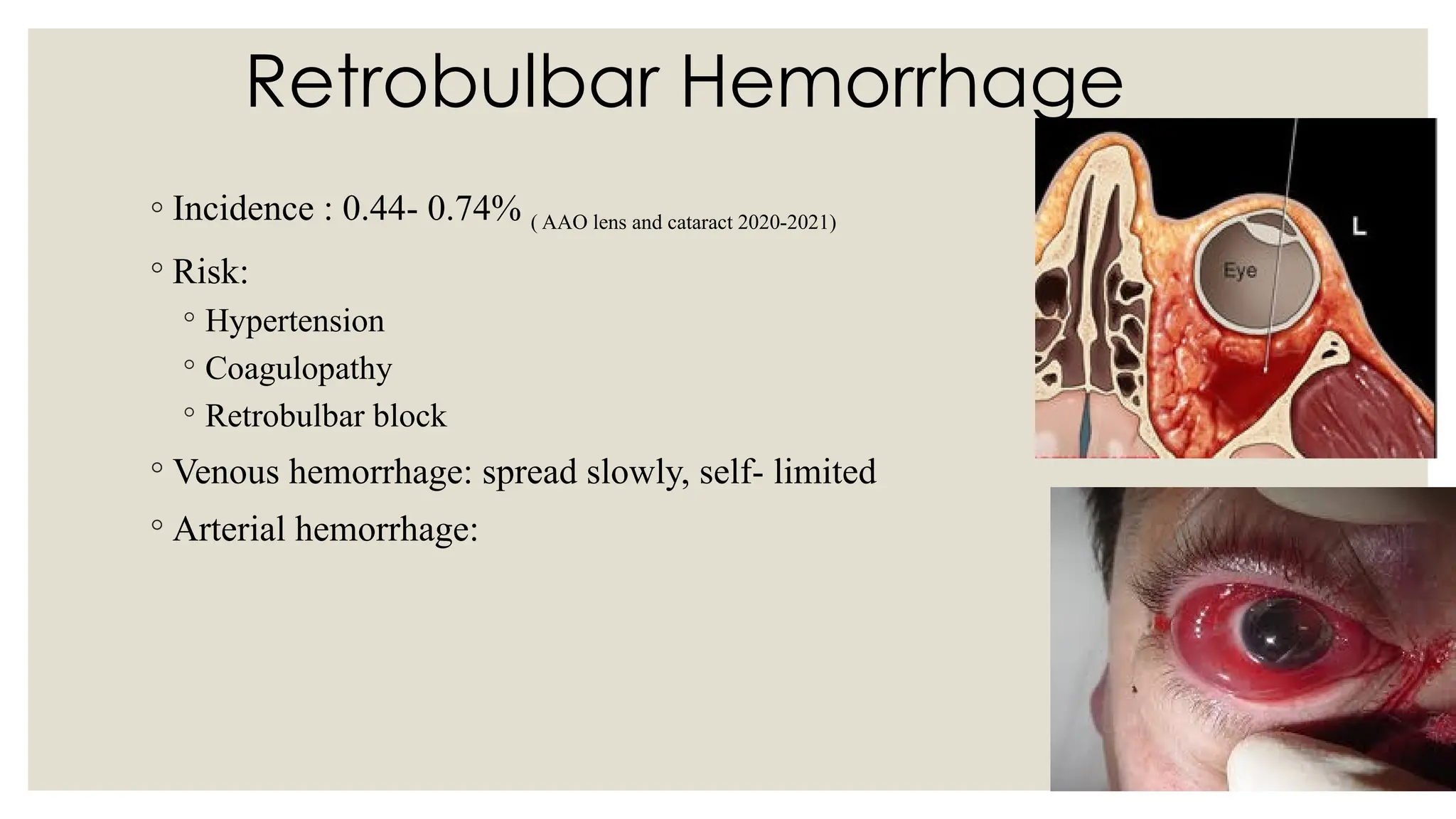 Retrobulbar Hemorrhage
◦ Incidence : 0.44- 0.74% ( AAO lens and cataract 2020-2021)
◦ Risk:
◦ Hypertension
◦ Coagulopathy
◦ Retrobulbar block
◦ Venous hemorrhage: spread slowly, self- limited
◦ Arterial hemorrhage:
 