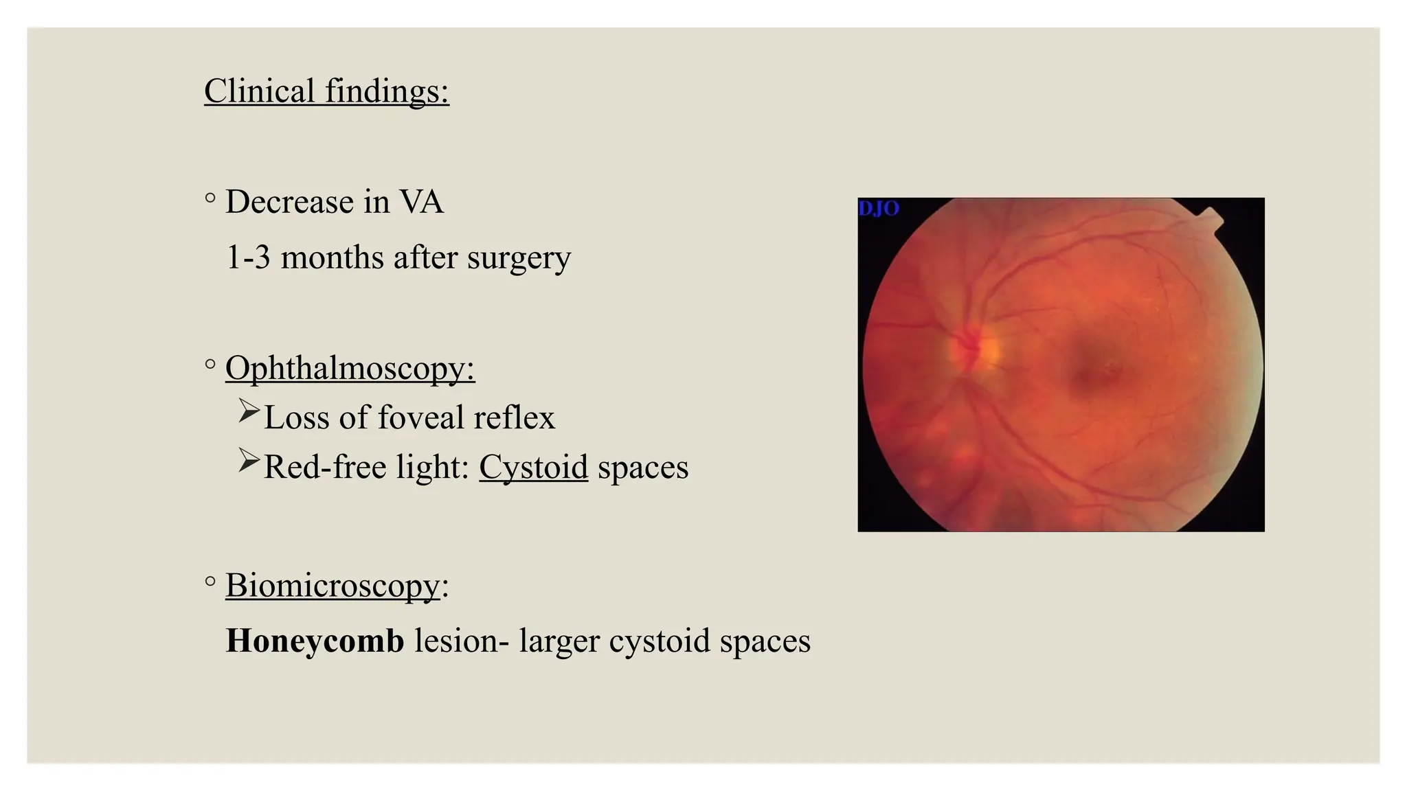 Clinical findings:
◦ Decrease in VA
1-3 months after surgery
◦ Ophthalmoscopy:
Loss of foveal reflex
Red-free light: Cystoid spaces
◦ Biomicroscopy:
Honeycomb lesion- larger cystoid spaces
 
