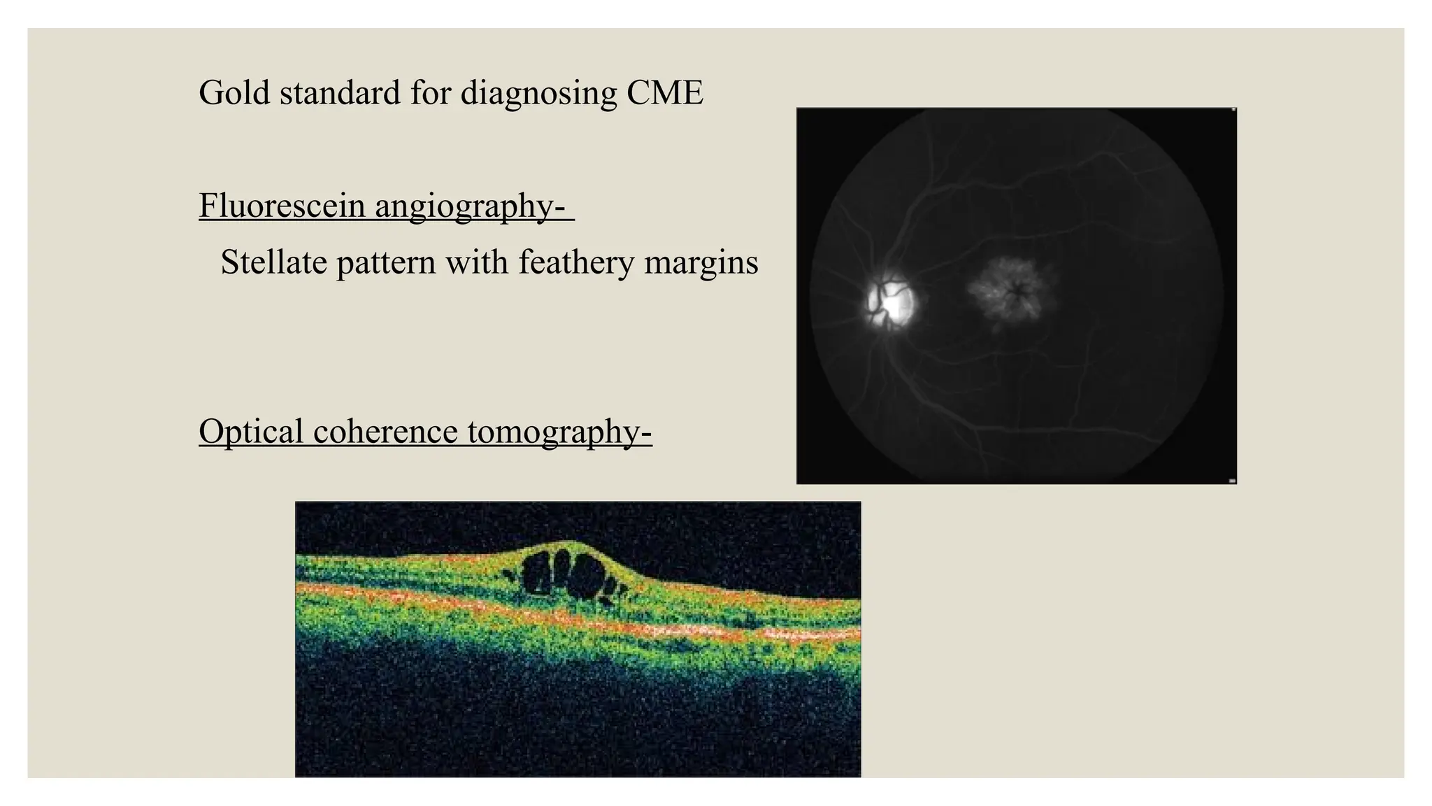Gold standard for diagnosing CME
Fluorescein angiography-
Stellate pattern with feathery margins
Optical coherence tomography-
 