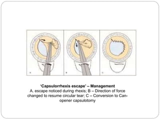 Complications of cataract surgery | PPTX