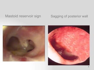 Complications of Chronic Otitis Media | PPTX