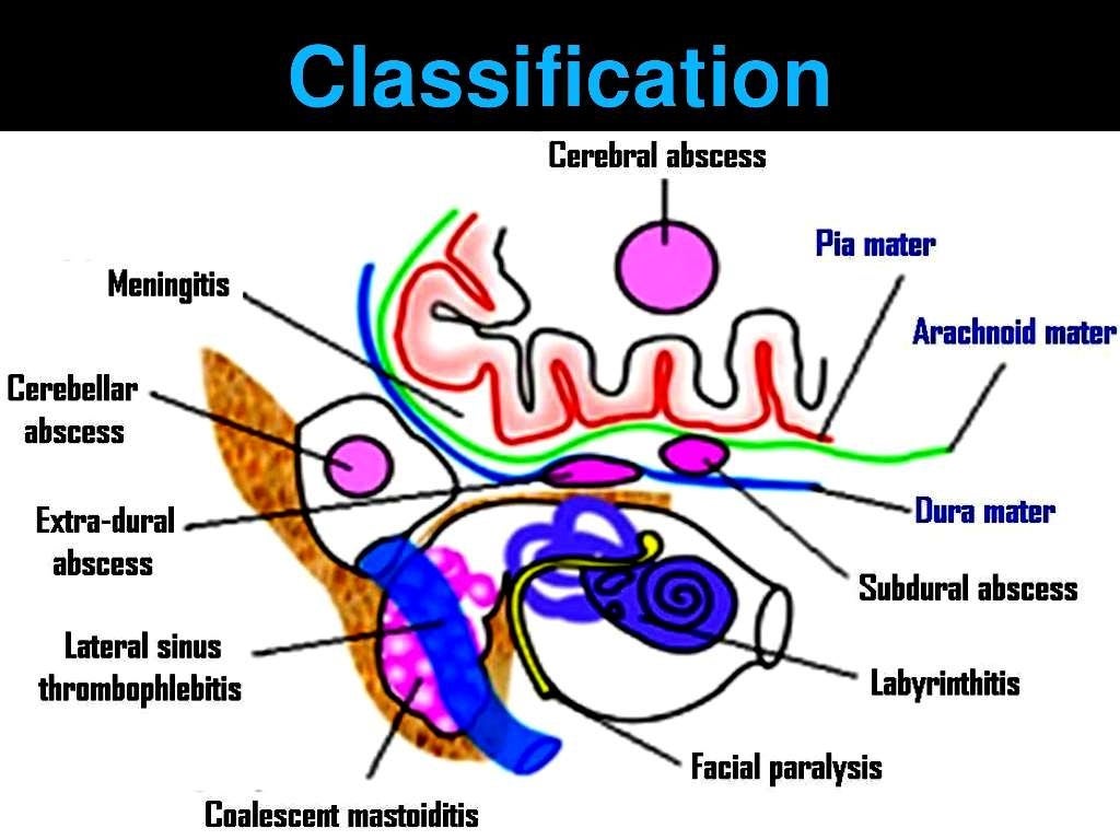 complications-of-csom