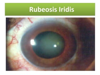 Subtle Rubeosis COMPLICATIONS OF DIABETES BY DR BASHIR AHMED DAR ASSOCIATE PROFESSOR ...
