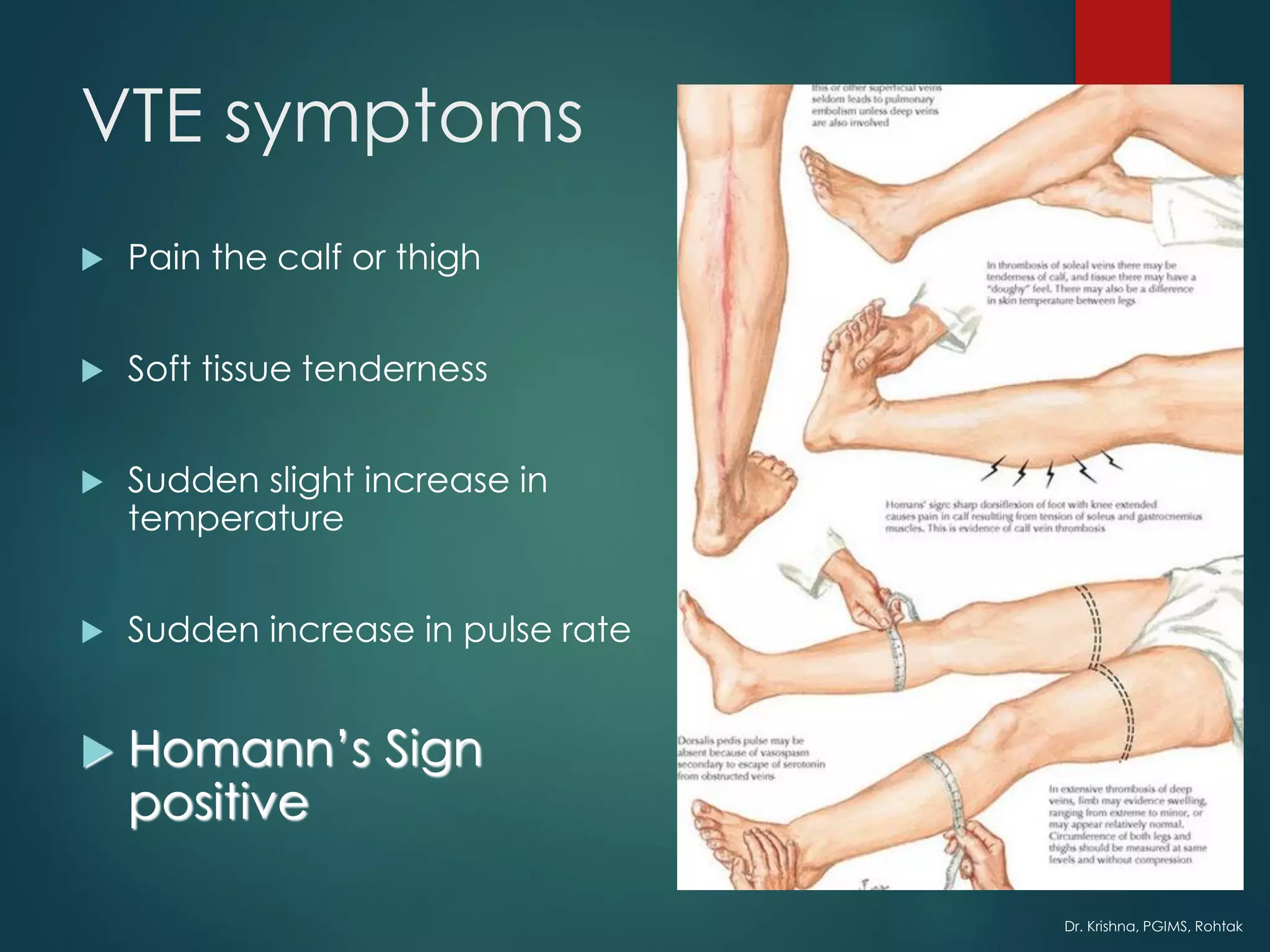 Dr. Krishna, PGIMS, Rohtak
VTE symptoms
 Pain the calf or thigh
 Soft tissue tenderness
 Sudden slight increase in
temperature
 Sudden increase in pulse rate
 Homann’s Sign
positive
 