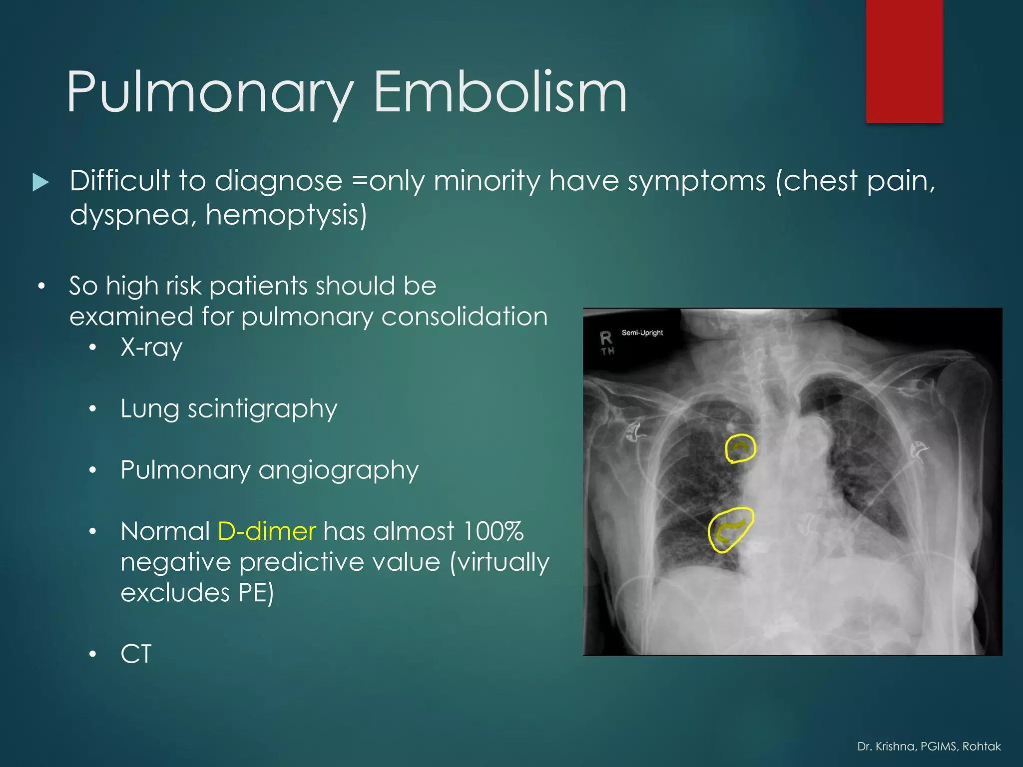 Dr. Krishna, PGIMS, Rohtak
Pulmonary Embolism
 Difficult to diagnose =only minority have symptoms (chest pain,
dyspnea, hemoptysis)
• So high risk patients should be
examined for pulmonary consolidation
• X-ray
• Lung scintigraphy
• Pulmonary angiography
• Normal D-dimer has almost 100%
negative predictive value (virtually
excludes PE)
• CT
 