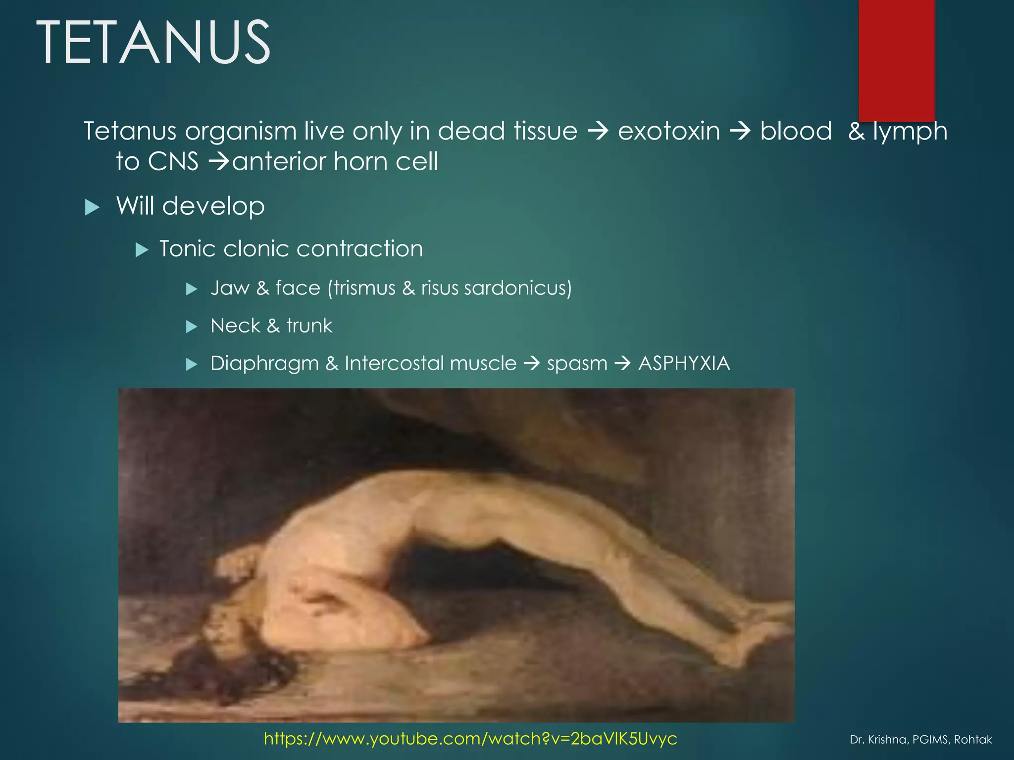 Dr. Krishna, PGIMS, Rohtak
TETANUS
Tetanus organism live only in dead tissue → exotoxin → blood & lymph
to CNS →anterior horn cell
 Will develop
 Tonic clonic contraction
 Jaw & face (trismus & risus sardonicus)
 Neck & trunk
 Diaphragm & Intercostal muscle → spasm → ASPHYXIA
https://www.youtube.com/watch?v=2baVlK5Uvyc
 