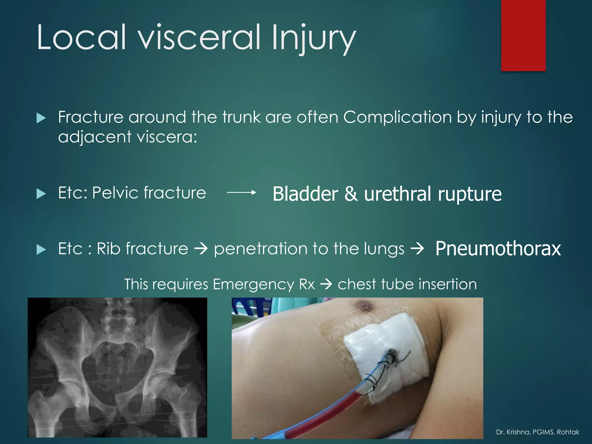 Dr. Krishna, PGIMS, Rohtak
Local visceral Injury
 Fracture around the trunk are often Complication by injury to the
adjacent viscera:
 Etc: Pelvic fracture
 Etc : Rib fracture → penetration to the lungs → Pneumothorax
Bladder & urethral rupture
This requires Emergency Rx → chest tube insertion
 
