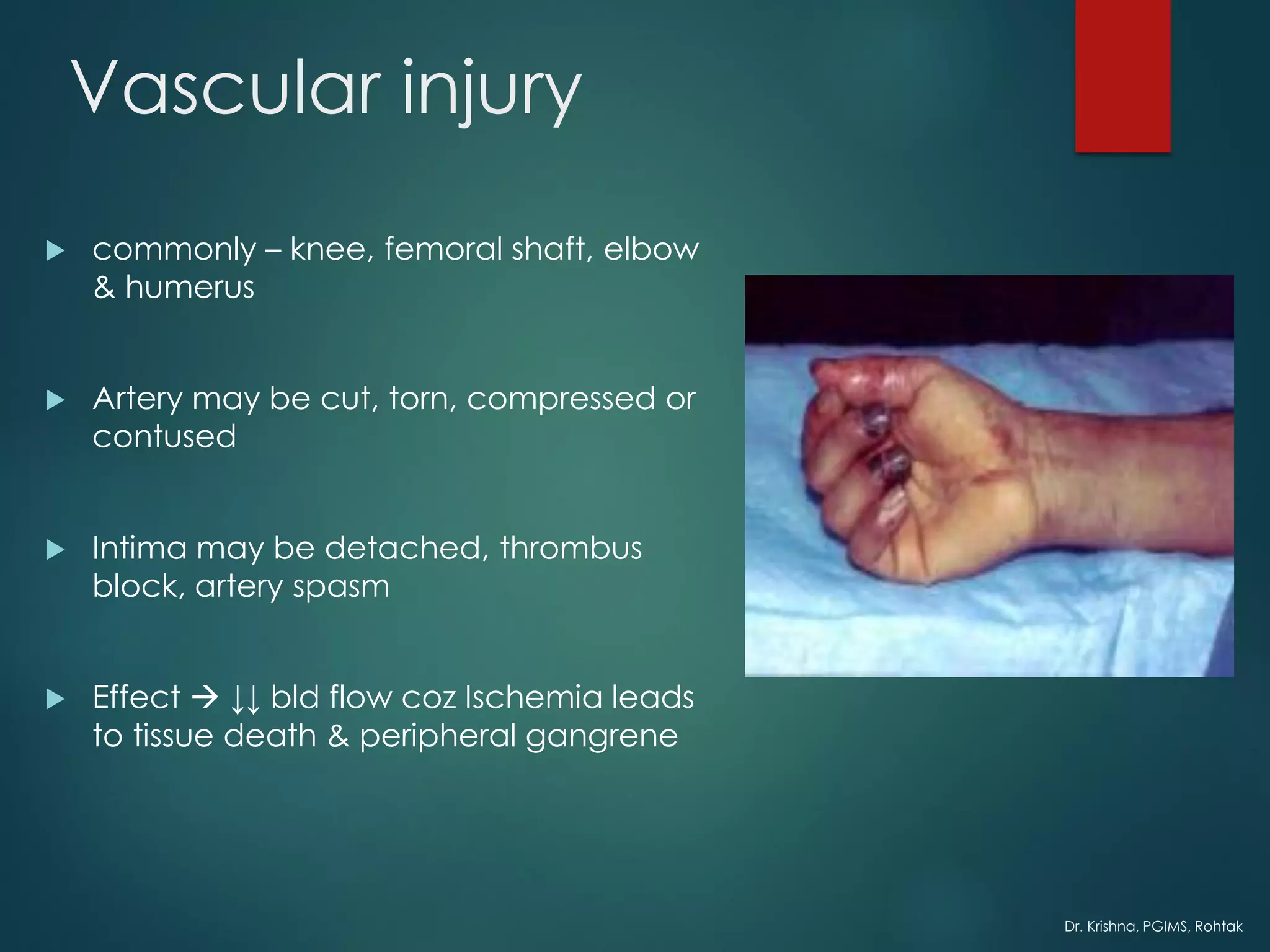Dr. Krishna, PGIMS, Rohtak
Vascular injury
 commonly – knee, femoral shaft, elbow
& humerus
 Artery may be cut, torn, compressed or
contused
 Intima may be detached, thrombus
block, artery spasm
 Effect → ↓↓ bld flow coz Ischemia leads
to tissue death & peripheral gangrene
 