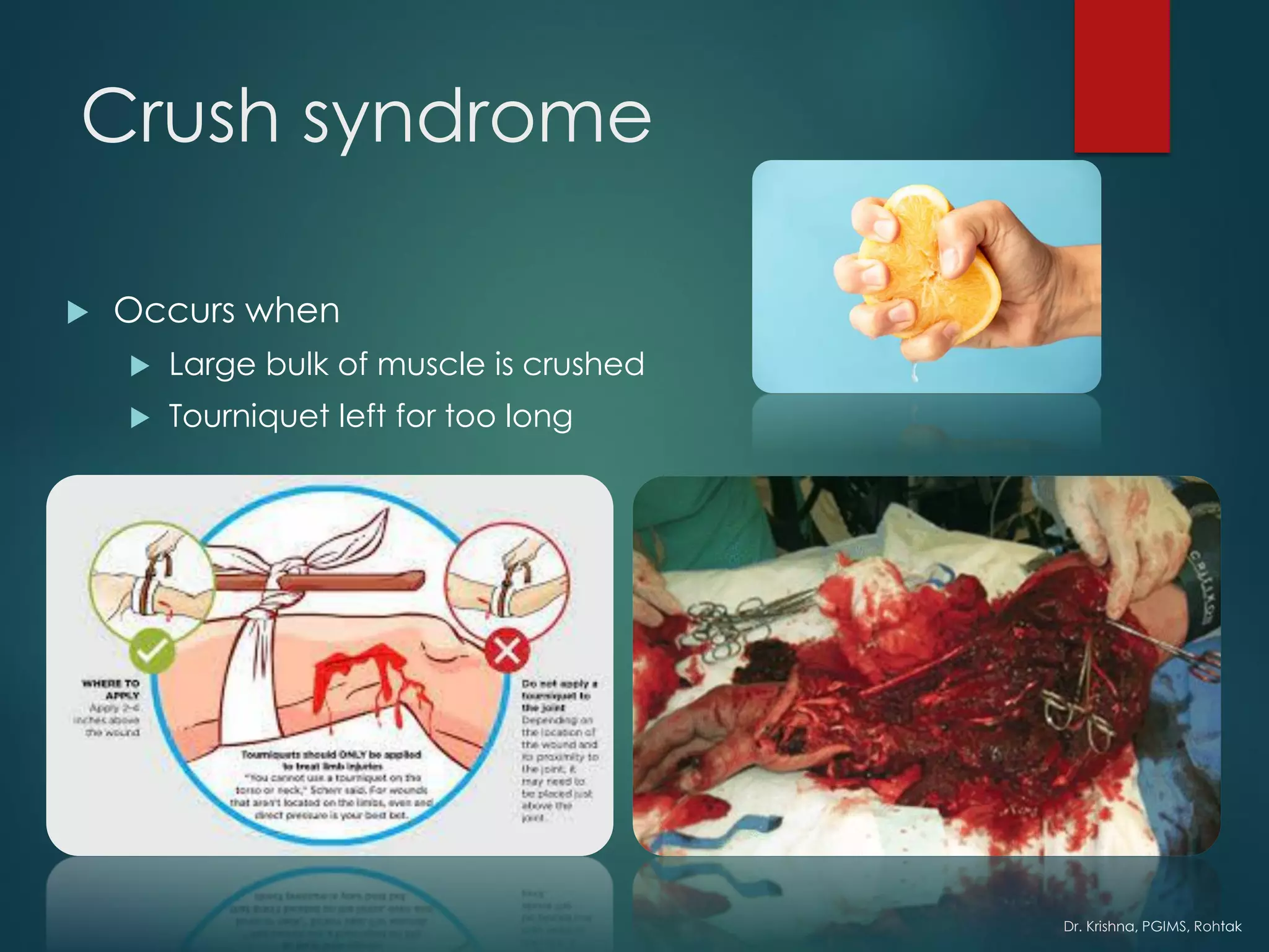 Dr. Krishna, PGIMS, Rohtak
Crush syndrome
 Occurs when
 Large bulk of muscle is crushed
 Tourniquet left for too long
 