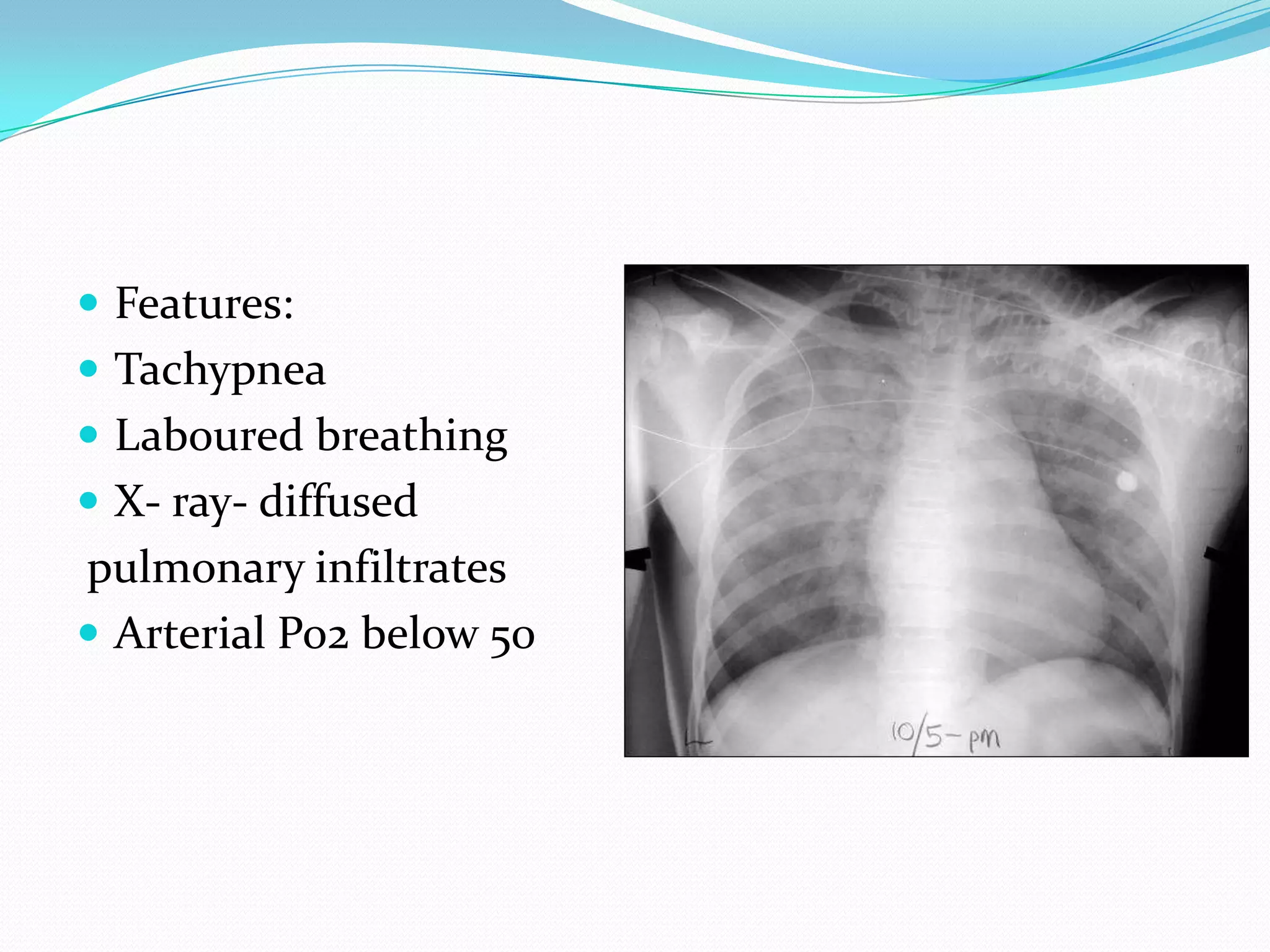  Features:
 Tachypnea
 Laboured breathing
 X- ray- diffused
pulmonary infiltrates
 Arterial Po2 below 50
 