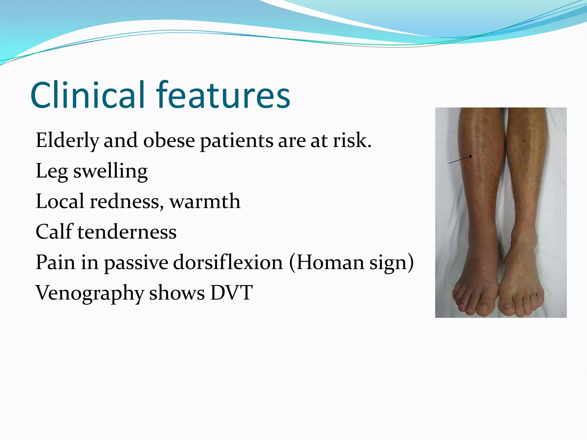 Clinical features
Elderly and obese patients are at risk.
Leg swelling
Local redness, warmth
Calf tenderness
Pain in passive dorsiflexion (Homan sign)
Venography shows DVT
 