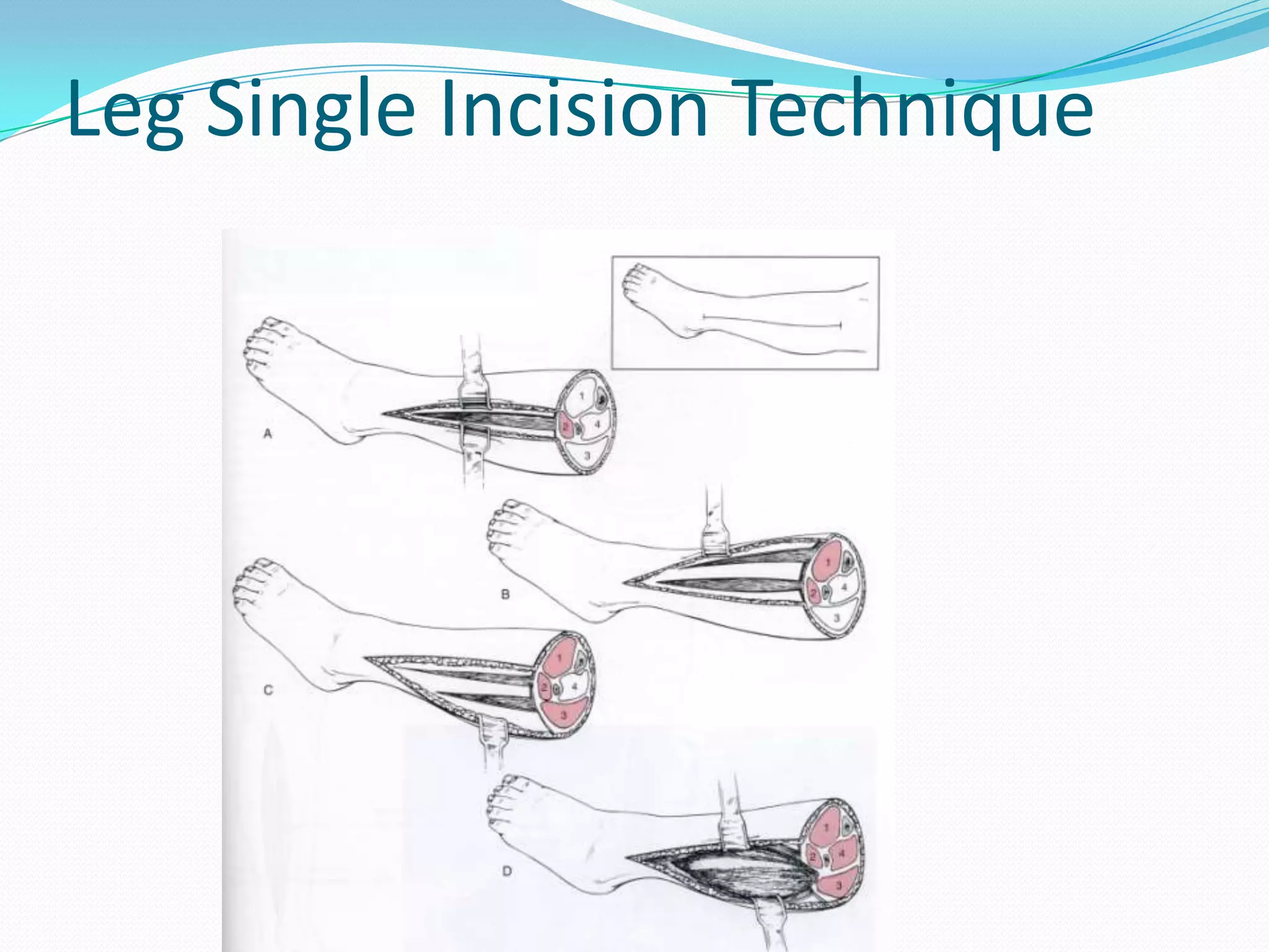 Leg Single Incision Technique
 