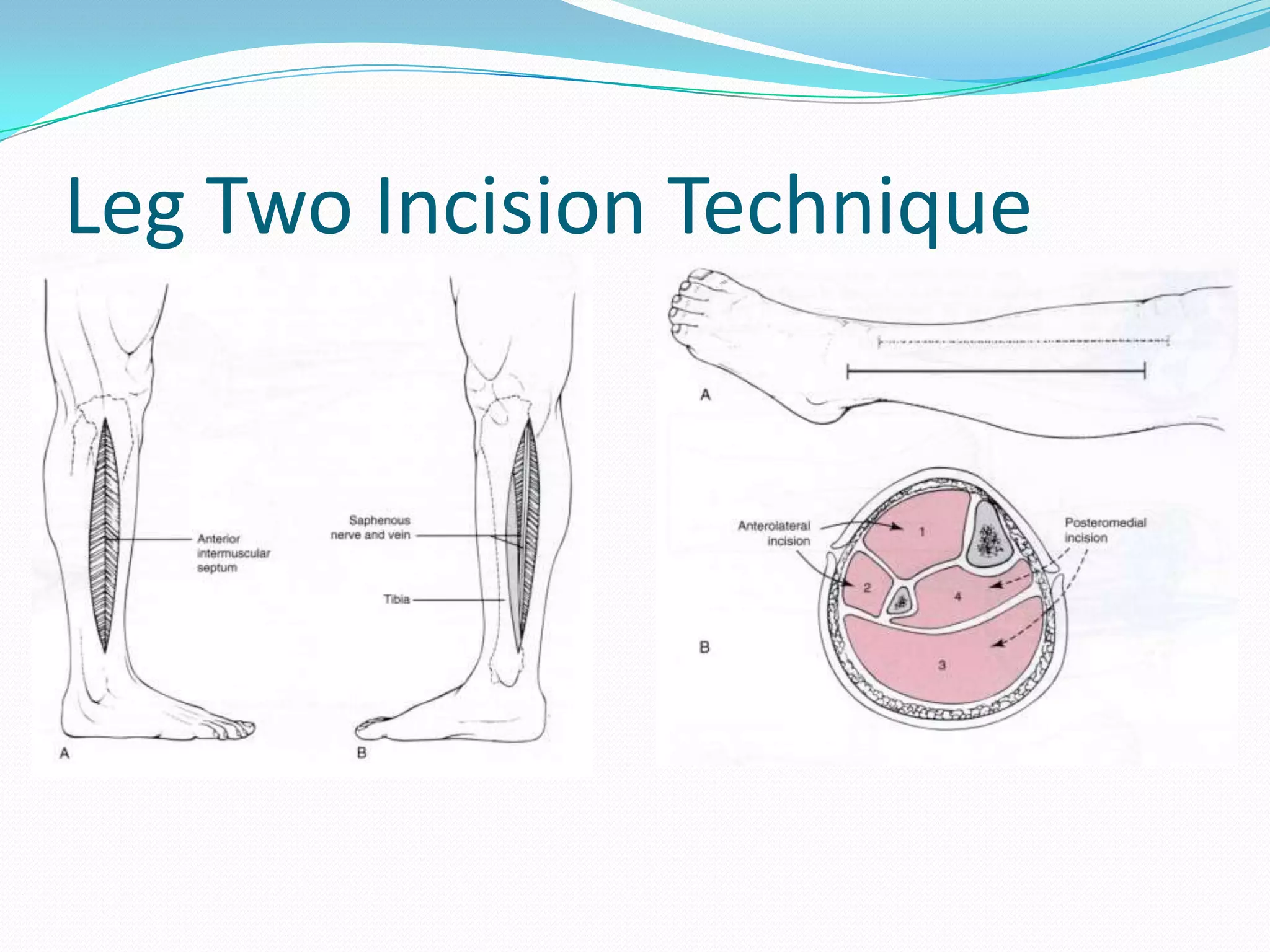 Leg Two Incision Technique
 
