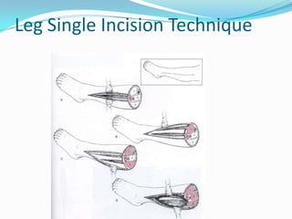 Leg Incision Types Complications of fractures | PPTX