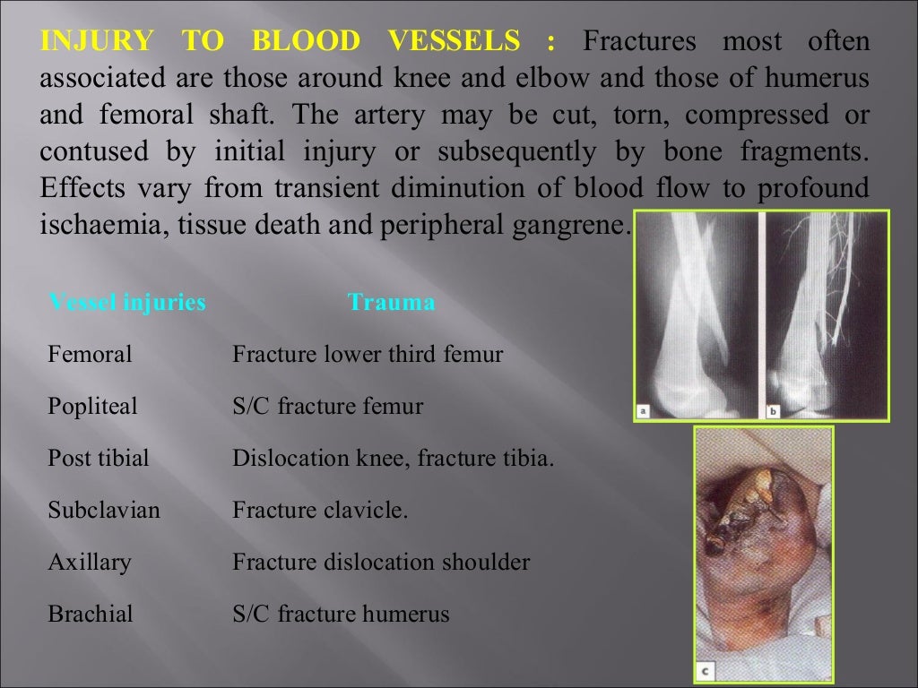 Complications of fractures 3.pptnew