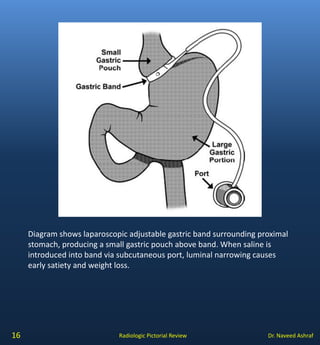 Complications of gastric surgery | PDF