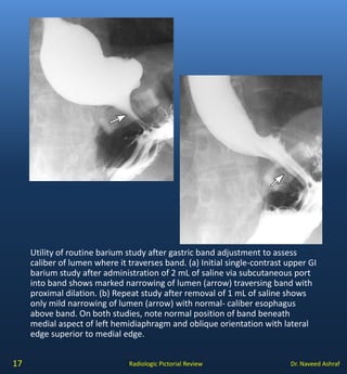 Hampton Line Complications of gastric surgery | PDF