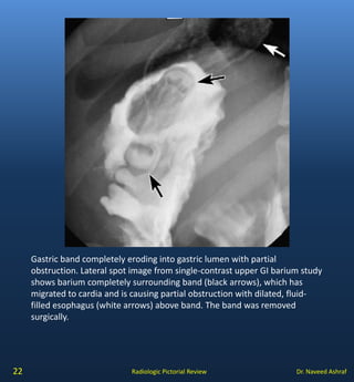 Hampton Line Complications of gastric surgery | PDF