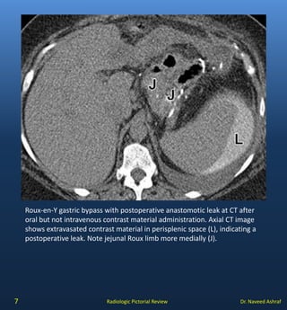 Complications of gastric surgery | PDF
