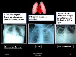 COMPLICATIONS OF HYPERTENSIVE DISORDERS OF PREGNANCY BY DR SHASHWAT ...