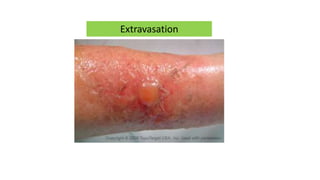 Complications of iv therapy and post exposure prophylaxis | PPTX