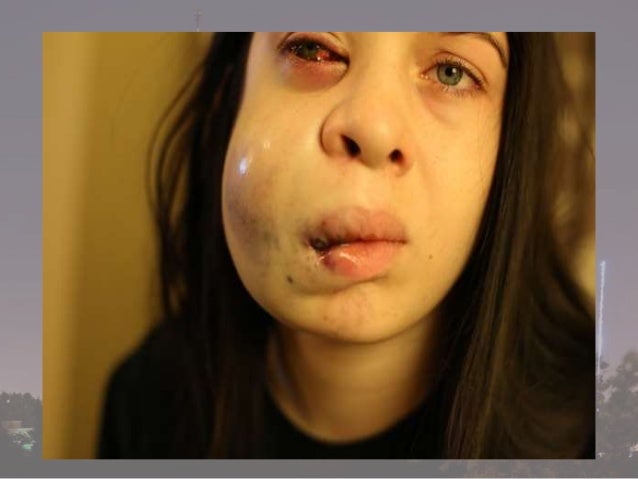 Complications Of Local Anasthesia In Dentistry