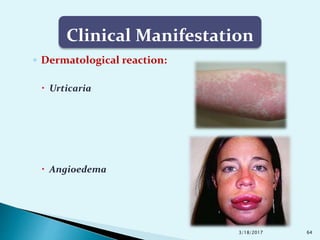 Complications of Local Anesthesia | PPTX