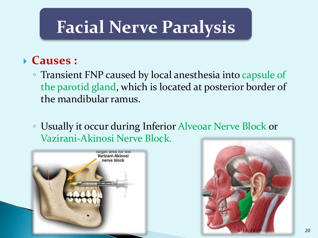 Complications of Local Anesthesia