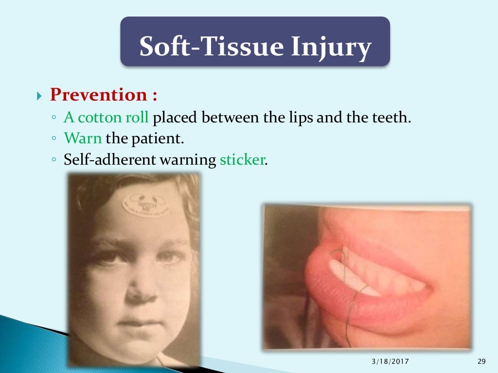 Complications of Local Anesthesia