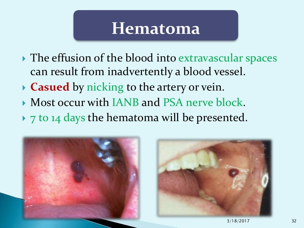 Complications of Local Anesthesia