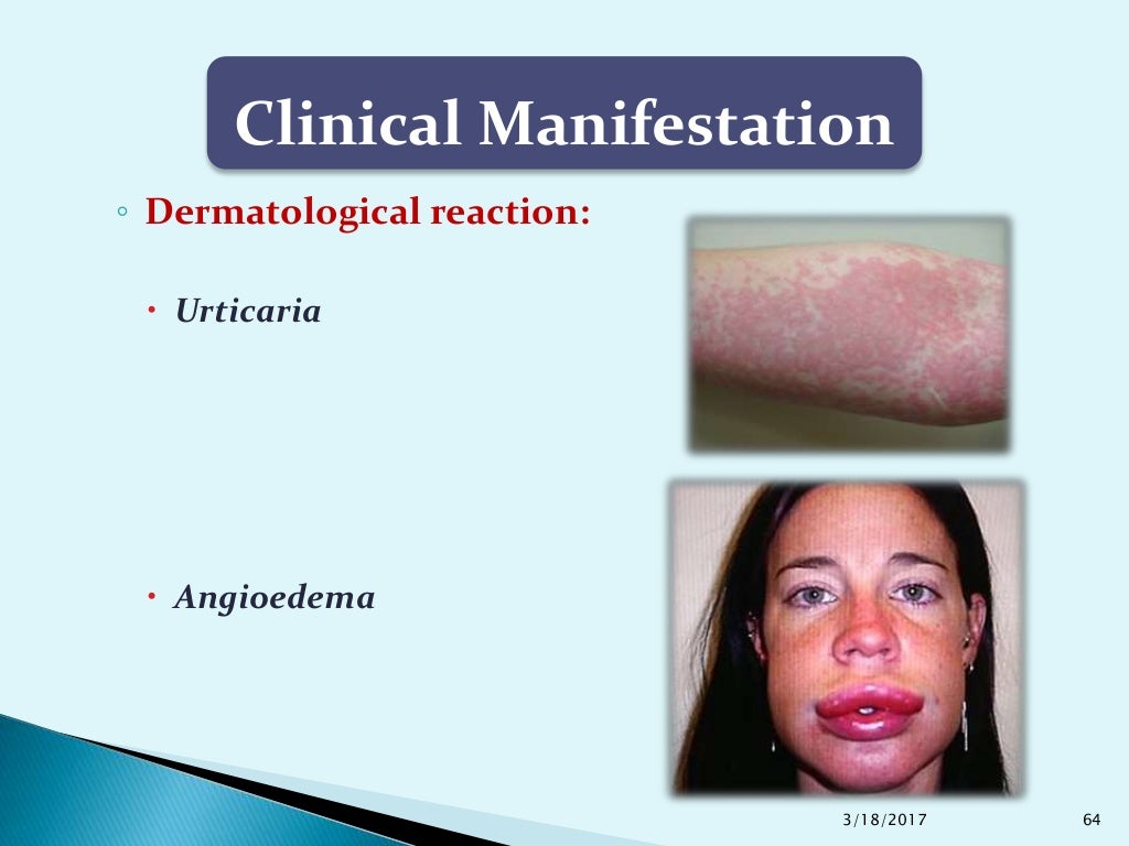 Complications of Local Anesthesia