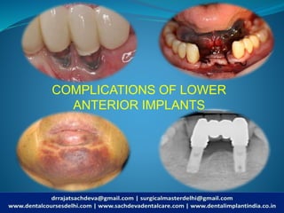 COMPLICATIONS OF LOWER
ANTERIOR IMPLANTS
 