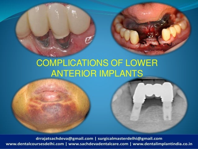 Complications Of Lower Anterior Implants Complications Of Dental Imp
